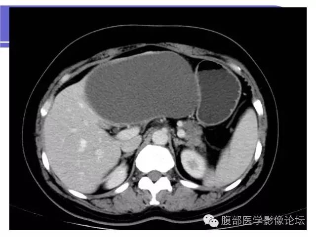 【病例】肝内胆管囊腺瘤1例CT影像表现 【病例】肝内胆管囊腺瘤1例CT影像表现