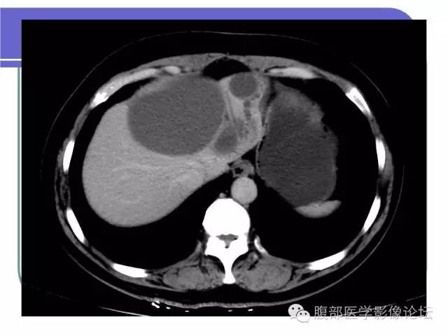 【病例】肝内胆管囊腺瘤1例CT影像表现 【病例】肝内胆管囊腺瘤1例CT影像表现