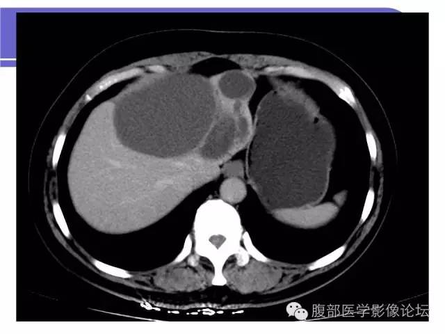 【病例】肝内胆管囊腺瘤1例CT影像表现 【病例】肝内胆管囊腺瘤1例CT影像表现