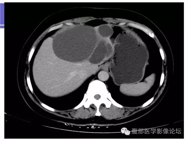 【病例】肝内胆管囊腺瘤1例CT影像表现 【病例】肝内胆管囊腺瘤1例CT影像表现