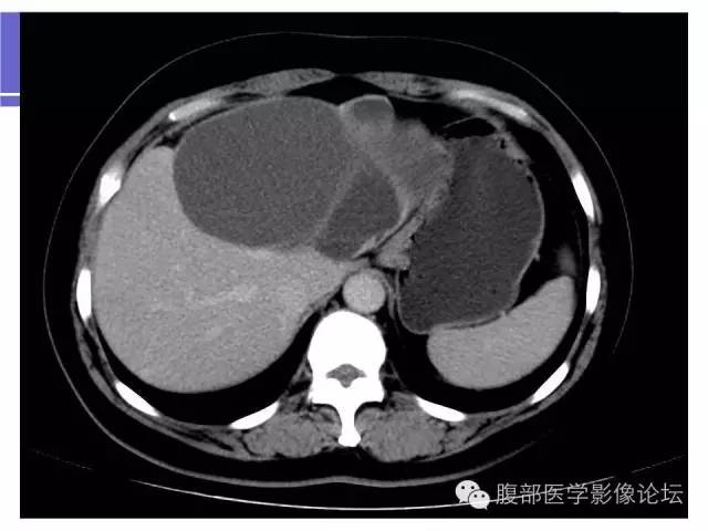 【病例】肝内胆管囊腺瘤1例CT影像表现 【病例】肝内胆管囊腺瘤1例CT影像表现