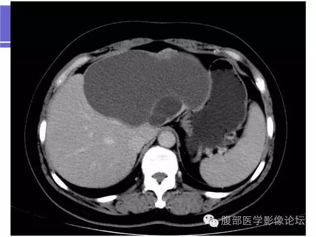 【病例】肝内胆管囊腺瘤1例CT影像表现 【病例】肝内胆管囊腺瘤1例CT影像表现