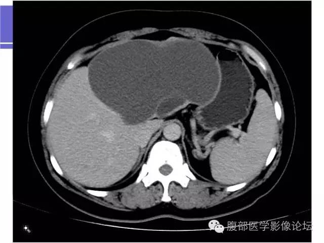 【病例】肝内胆管囊腺瘤1例CT影像表现 【病例】肝内胆管囊腺瘤1例CT影像表现