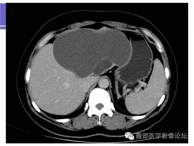 【病例】肝内胆管囊腺瘤1例CT影像表现 【病例】肝内胆管囊腺瘤1例CT影像表现