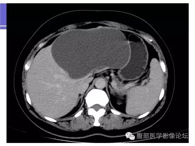 【病例】肝内胆管囊腺瘤1例CT影像表现 【病例】肝内胆管囊腺瘤1例CT影像表现