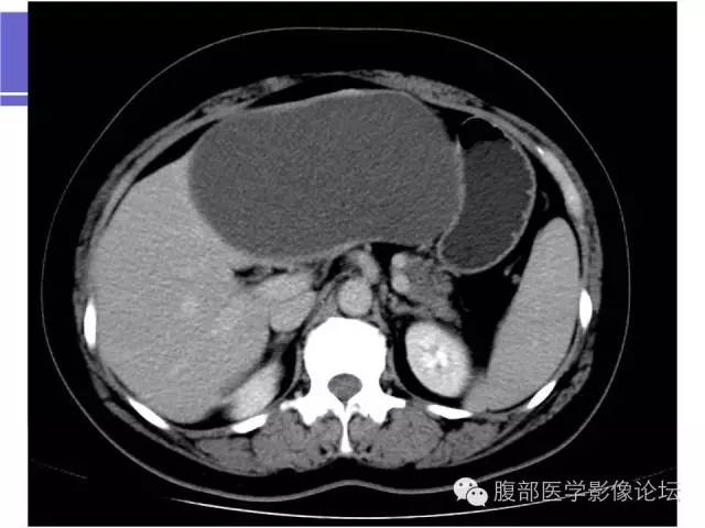 【病例】肝内胆管囊腺瘤1例CT影像表现 【病例】肝内胆管囊腺瘤1例CT影像表现