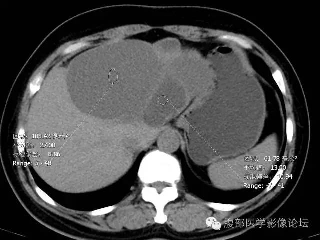 【病例】肝内胆管囊腺瘤1例CT影像表现 【病例】肝内胆管囊腺瘤1例CT影像表现