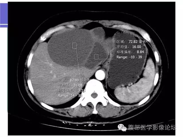 【病例】肝内胆管囊腺瘤1例CT影像表现 【病例】肝内胆管囊腺瘤1例CT影像表现