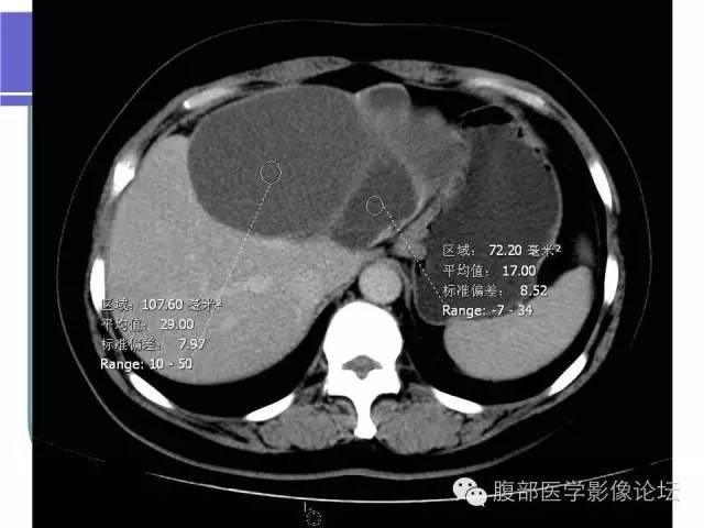 【病例】肝内胆管囊腺瘤1例CT影像表现 【病例】肝内胆管囊腺瘤1例CT影像表现