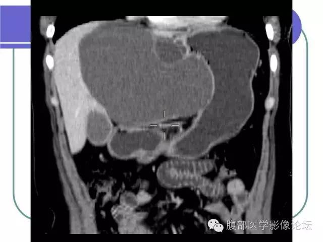 【病例】肝内胆管囊腺瘤1例CT影像表现 【病例】肝内胆管囊腺瘤1例CT影像表现