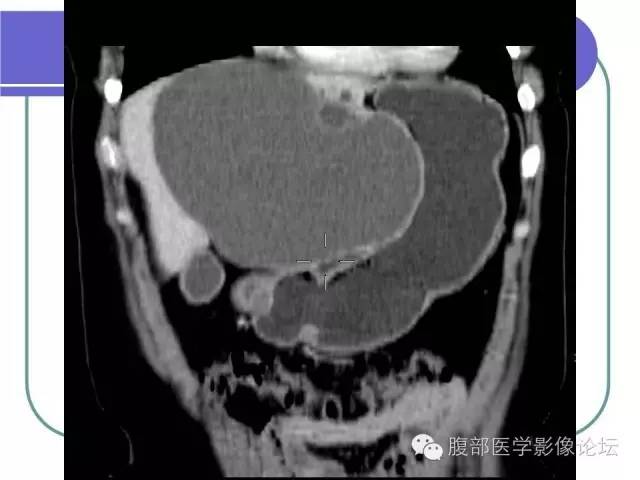 【病例】肝内胆管囊腺瘤1例CT影像表现 【病例】肝内胆管囊腺瘤1例CT影像表现