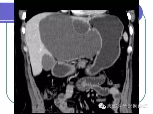 【病例】肝内胆管囊腺瘤1例CT影像表现 【病例】肝内胆管囊腺瘤1例CT影像表现