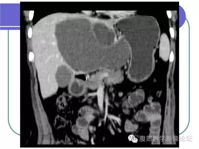 【病例】肝内胆管囊腺瘤1例CT影像表现 【病例】肝内胆管囊腺瘤1例CT影像表现