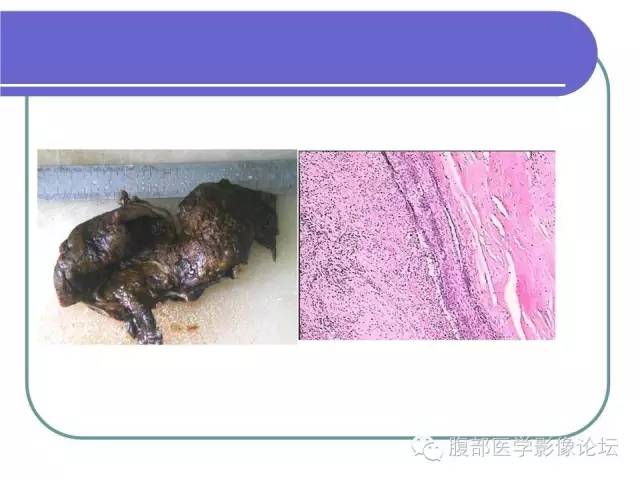 【病例】肝内胆管囊腺瘤1例CT影像表现 【病例】肝内胆管囊腺瘤1例CT影像表现