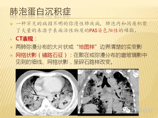【PPT】间质性肺疾病的鉴别诊断