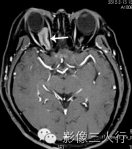 "视神经双轨征"，这个征象提示啥？