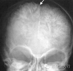 "车轨征"，这个征象提示啥？