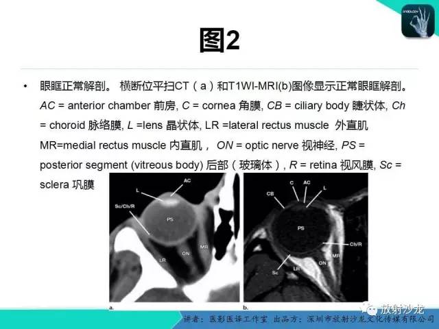 【PPT】眼球外伤-放射科医生能提供什么？