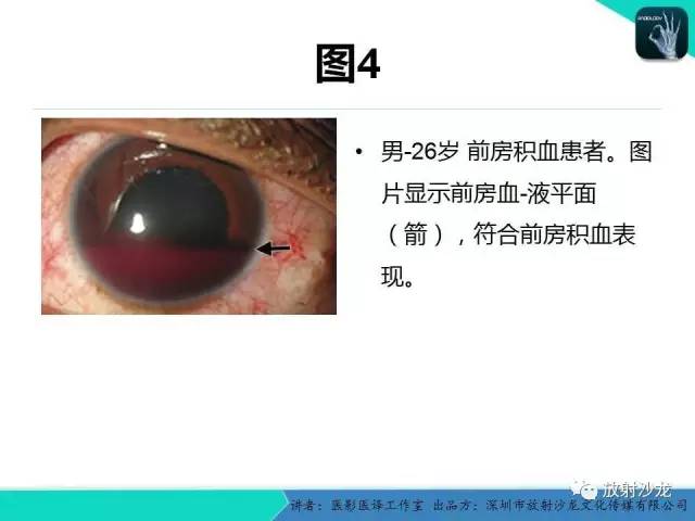【PPT】眼球外伤-放射科医生能提供什么？