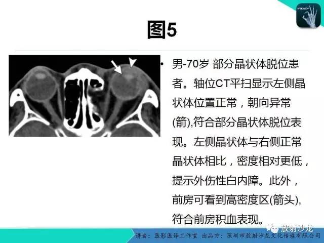 【PPT】眼球外伤-放射科医生能提供什么？