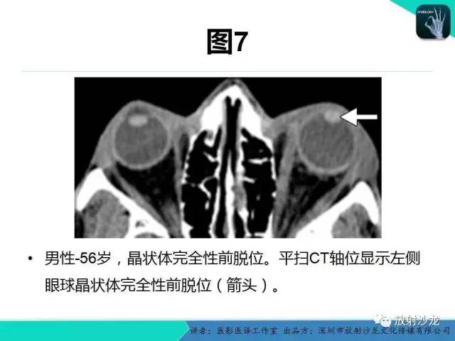 【PPT】眼球外伤-放射科医生能提供什么？