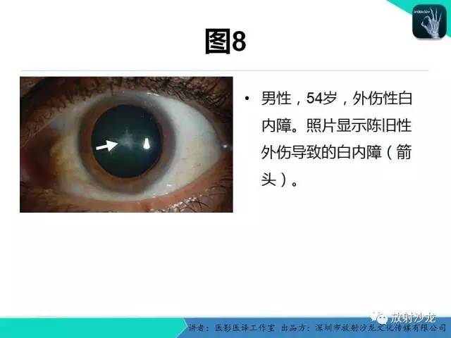【PPT】眼球外伤-放射科医生能提供什么？