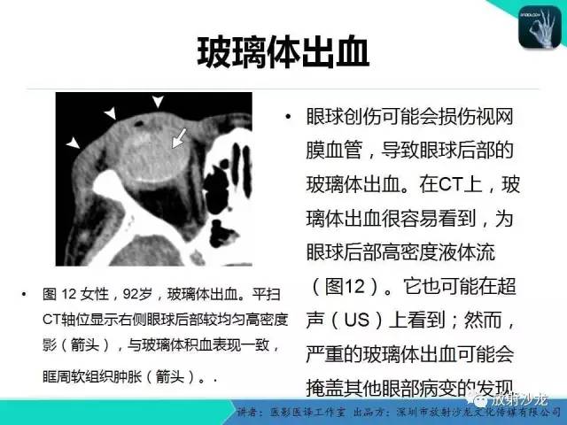 【PPT】眼球外伤-放射科医生能提供什么？