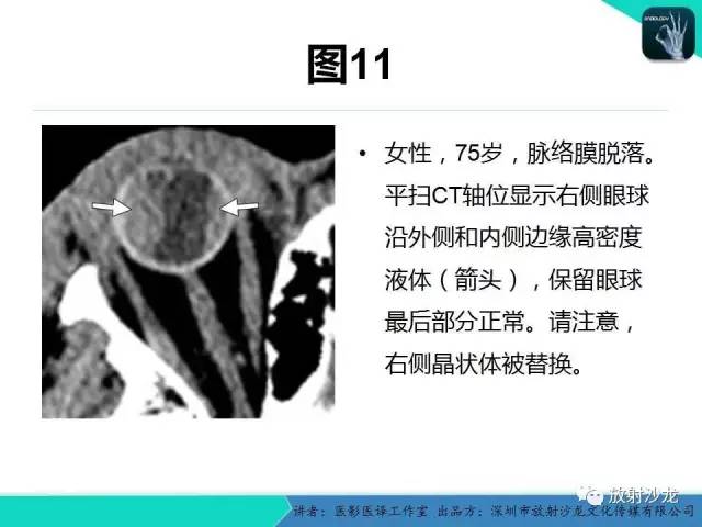 【PPT】眼球外伤-放射科医生能提供什么？