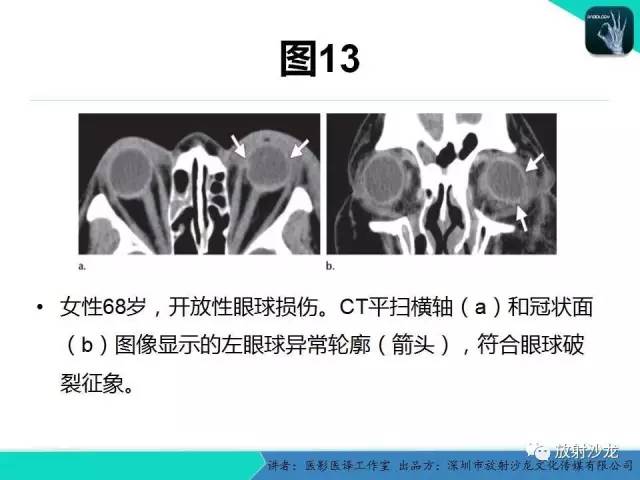 【PPT】眼球外伤-放射科医生能提供什么？