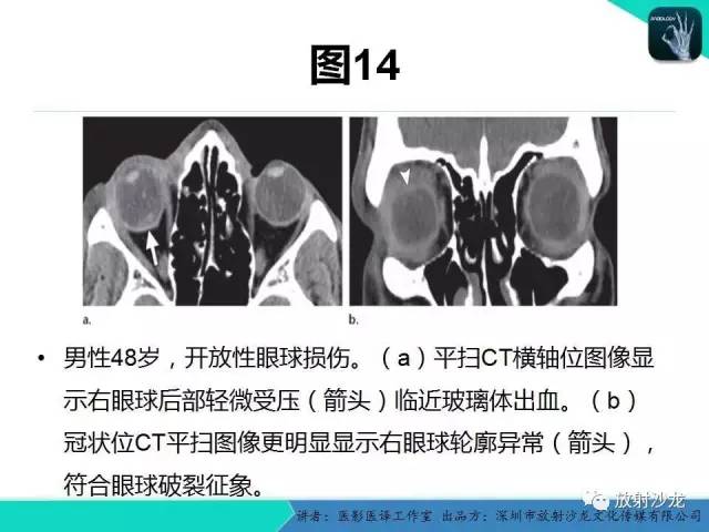 【PPT】眼球外伤-放射科医生能提供什么？