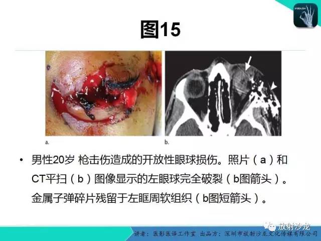【PPT】眼球外伤-放射科医生能提供什么？