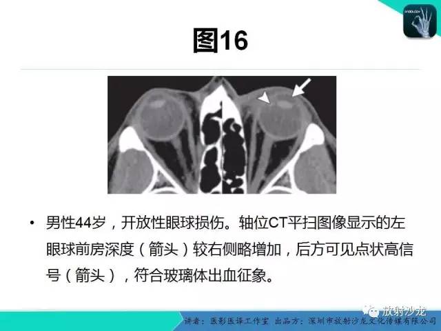 【PPT】眼球外伤-放射科医生能提供什么？