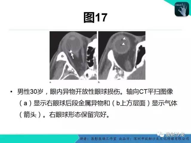 【PPT】眼球外伤-放射科医生能提供什么？