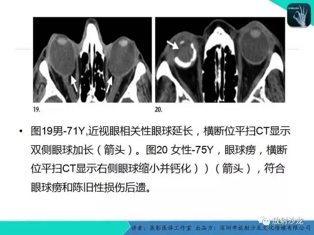 【PPT】眼球外伤-放射科医生能提供什么？