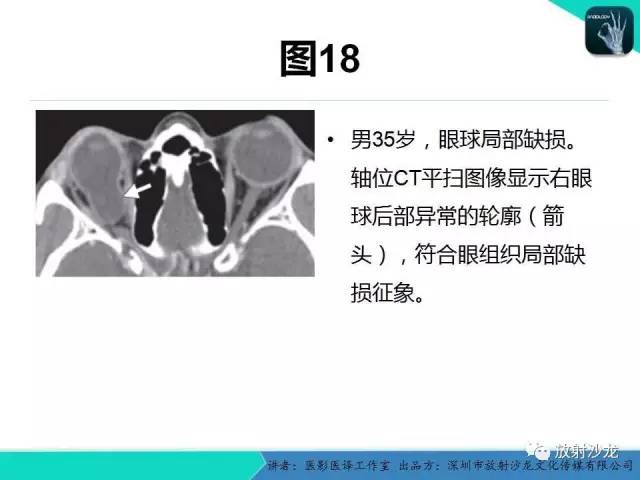 【PPT】眼球外伤-放射科医生能提供什么？
