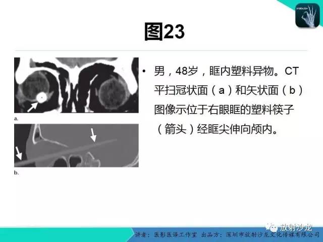 【PPT】眼球外伤-放射科医生能提供什么？