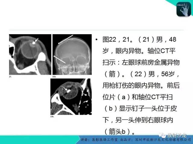 【PPT】眼球外伤-放射科医生能提供什么？