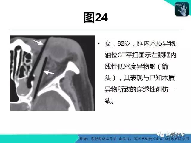 【PPT】眼球外伤-放射科医生能提供什么？