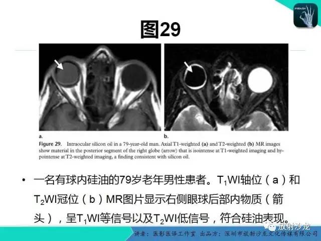 【PPT】眼球外伤-放射科医生能提供什么？