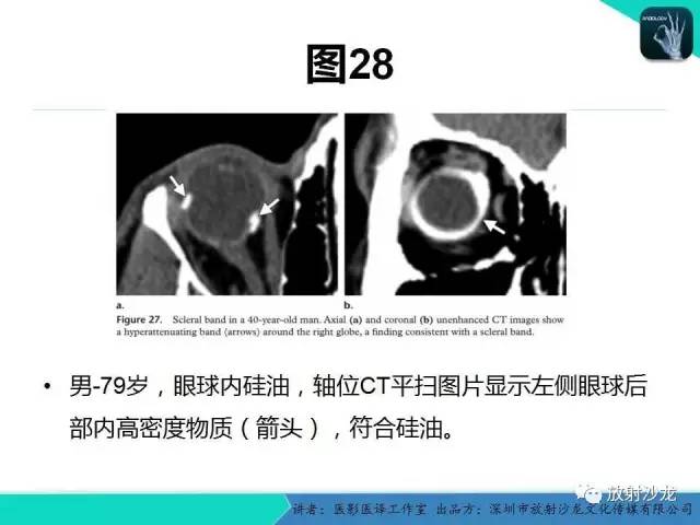 【PPT】眼球外伤-放射科医生能提供什么？