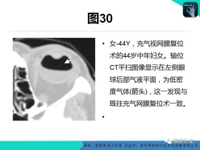 【PPT】眼球外伤-放射科医生能提供什么？