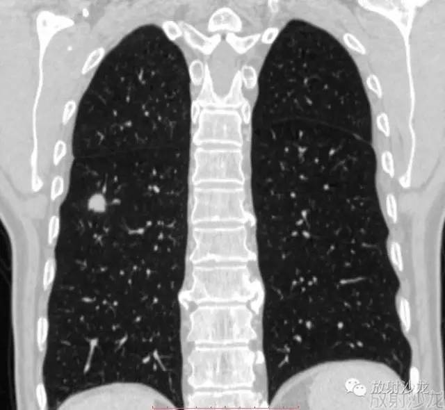 【病例】机化性肺炎1例CT影像表现 【病例】机化性肺炎1例CT影像表现