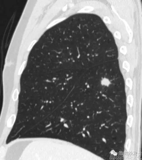 【病例】机化性肺炎1例CT影像表现 【病例】机化性肺炎1例CT影像表现