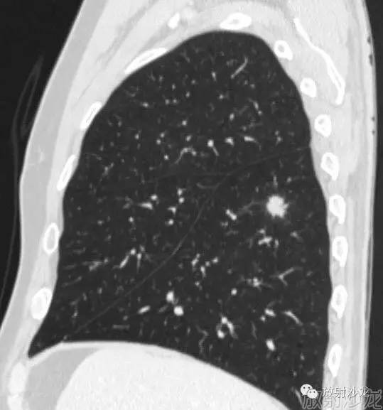 【病例】机化性肺炎1例CT影像表现 【病例】机化性肺炎1例CT影像表现