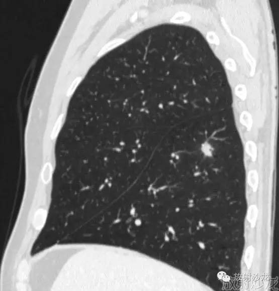 【病例】机化性肺炎1例CT影像表现 【病例】机化性肺炎1例CT影像表现
