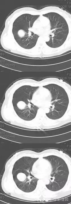 【病例】肺硬化性血管瘤1例CT影像表现与鉴别 【病例】肺硬化性血管瘤1例CT影像表现与鉴别