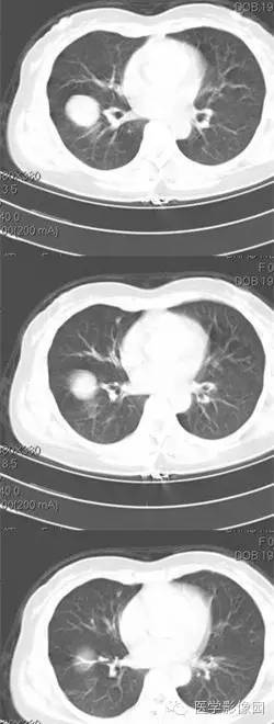 【病例】肺硬化性血管瘤1例CT影像表现与鉴别 【病例】肺硬化性血管瘤1例CT影像表现与鉴别