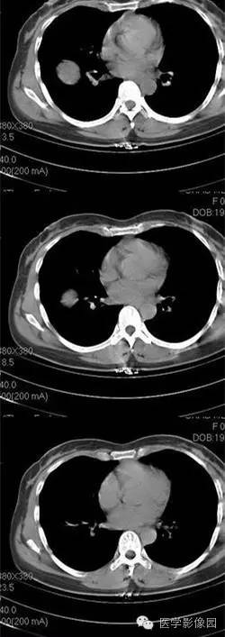 【病例】肺硬化性血管瘤1例CT影像表现与鉴别 【病例】肺硬化性血管瘤1例CT影像表现与鉴别