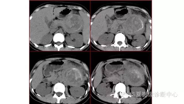 【病例】胰腺假性囊肿1例CT影像表现