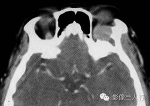 【病例】眼眶内皮样囊肿伴感染1例CT影像表现分析 【病例】眼眶内皮样囊肿伴感染1例CT影像表现分析
